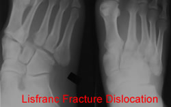 Lisfranc 1