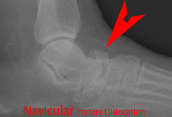 Navicular # 1