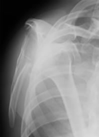 Fractured Scapula Lateral X-ray