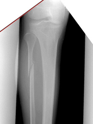 Maissoneuve fracture