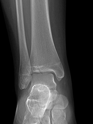 Tillaux fracture