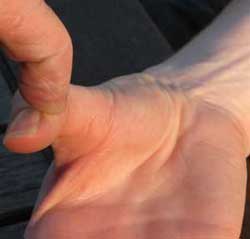 Median Nerve Moror LOAF muscles out of plane of palm
