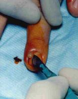 opening a paronychia