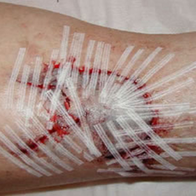 Pre-tibial  steristrips