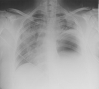 RupturedDiaphragm01