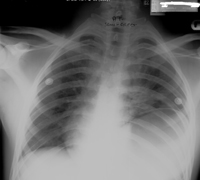 RupturedDiaphragm04
