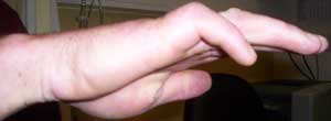 Ulnar Claw
