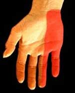 Sensory Distribution Ulnar Nerve in Hand