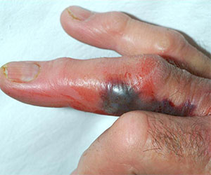 Tenosynovitis