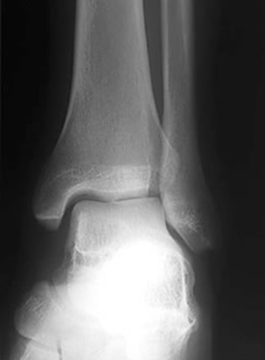 x-ray AP lateral