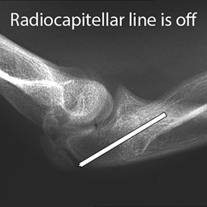 Radial head dislocation