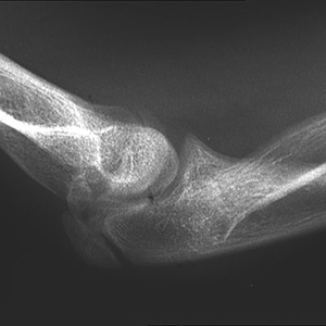 Radial head dislocation