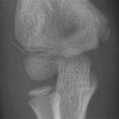Lateral Epicondyle fracture