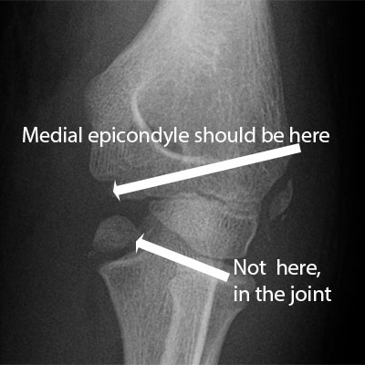 Medial Epicondyle fracture