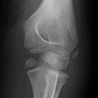 Medial Epicondyle fracture