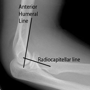 Elbow lateral lines padslabelled