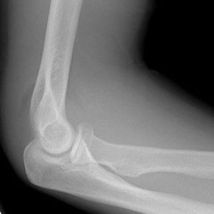 x-ray elbow lateral