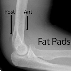 Elbow lateral pat padslabelled