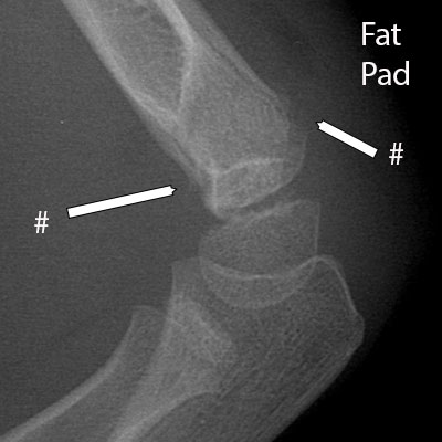 Supracondylar fracture