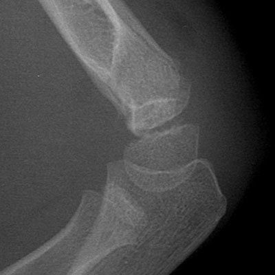 Supracondylar fracture