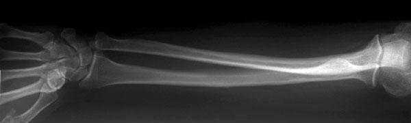 x-ray forearm AP view