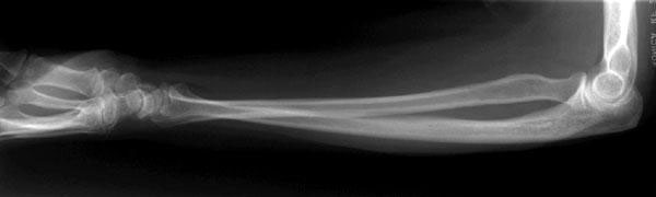 x-ray forearm lateral view