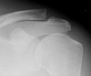 shoulder ac gap