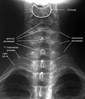 Cx spine AP