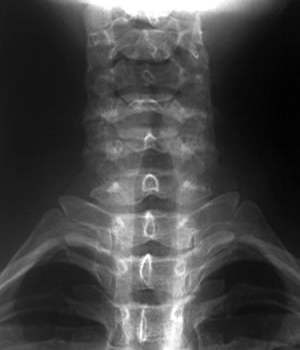 Cx spine AP