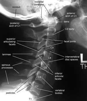 Cx spine lateral