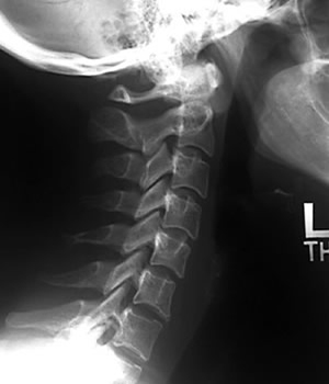 Cx spine lateral
