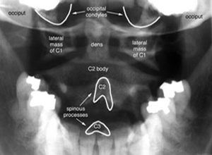 Cx spine open mouth