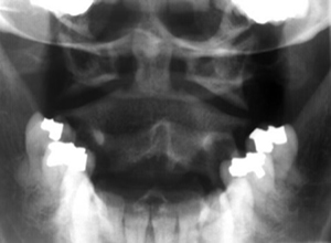 Cx spine open mouth