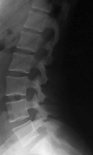 L spine lateral