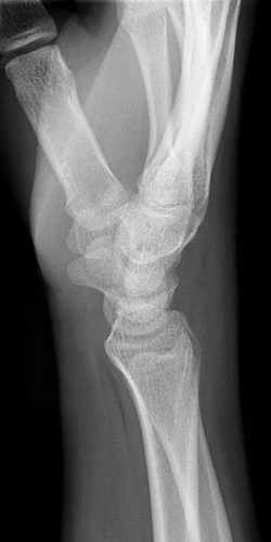 Wrist lateral view